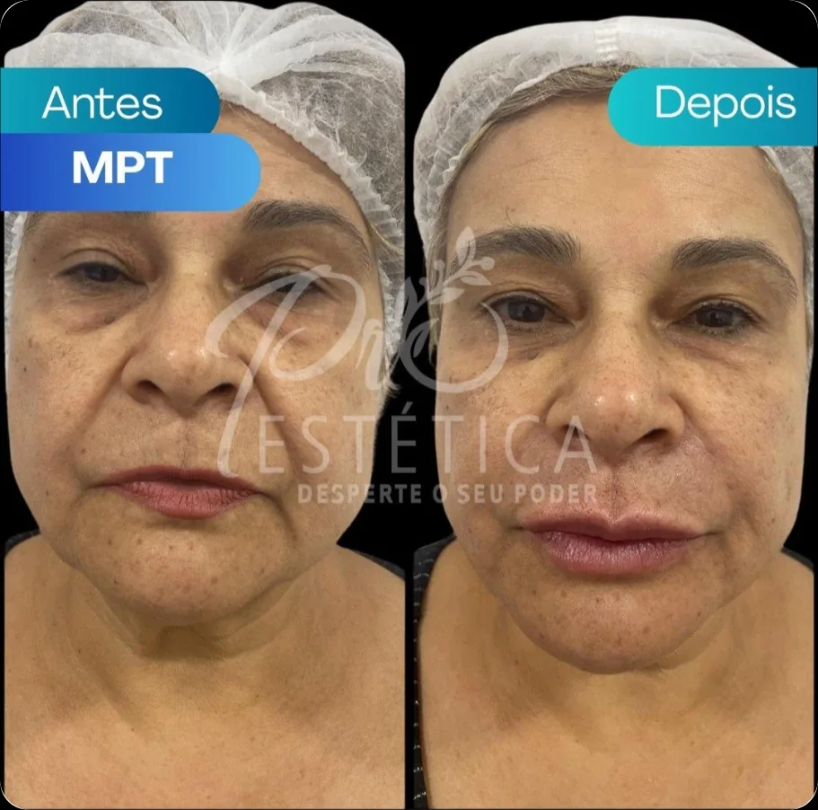 Rosto da mesma paciente antes e depois, lado a lado