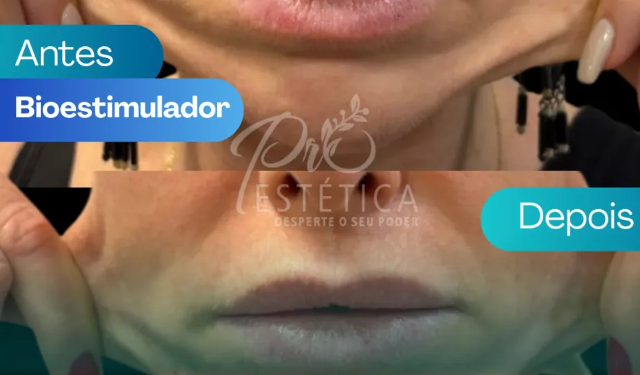 Antes e depois do bioestimulador Radiesse no contorno facial