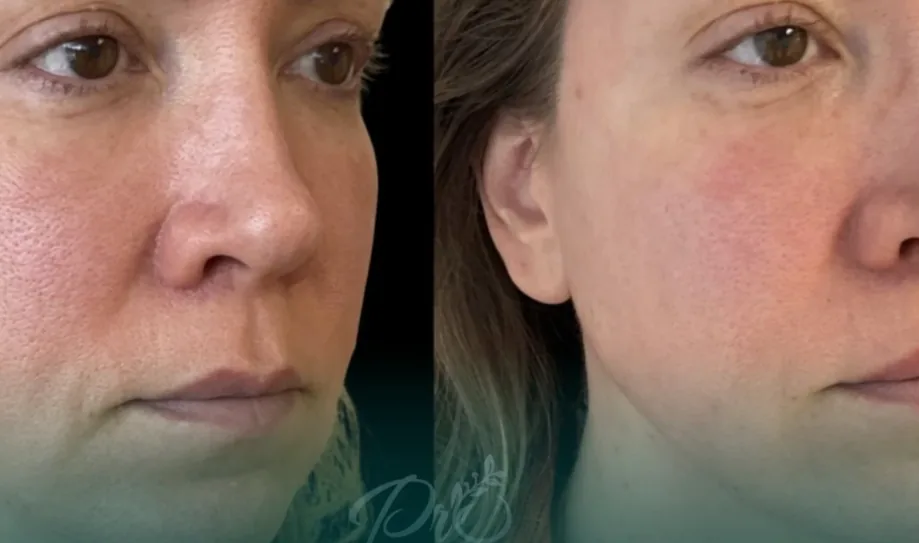 Antes e depois do tratamento com laser CO2 no rosto