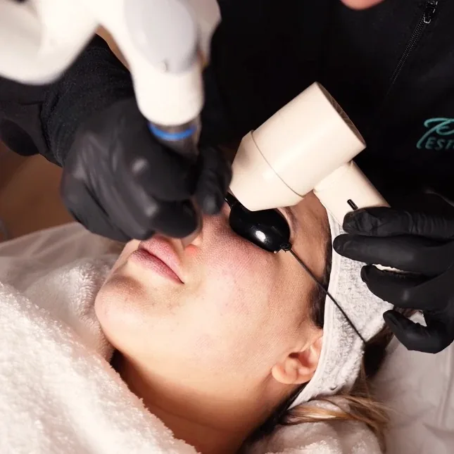 Profissional da Pró Estética aplicando um laser no rosto de uma cliente deitada, com óculos de proteção.
