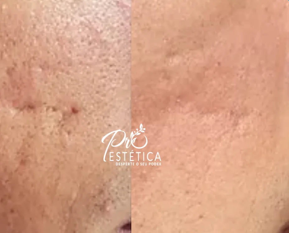 Pele do rosto com cicatrizes de acne, metade antes e metade depois